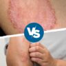 eczema vs ringworm